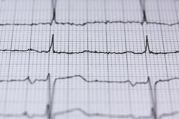eletrocardiograma saude