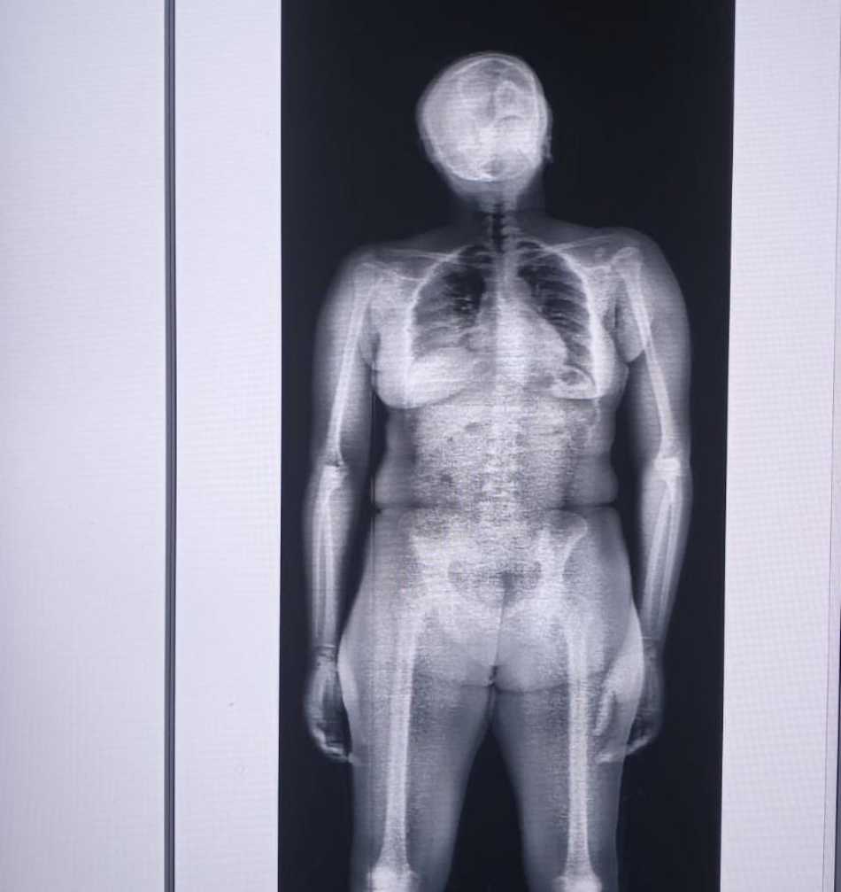 mulher bodyscan drogas copemcan abr 22